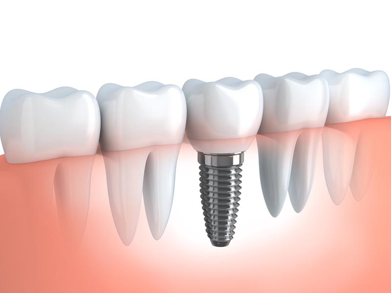 Dental Implants Highland Springs, VA 